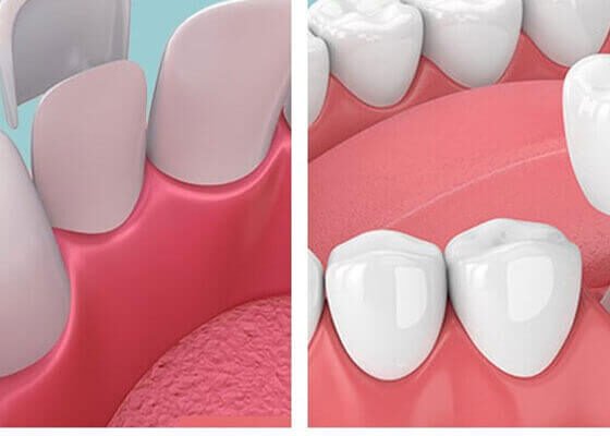 Understanding the Cost Dynamics of Dental Veneers vs. Crowns