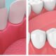 Understanding the Cost Dynamics of Dental Veneers vs. Crowns