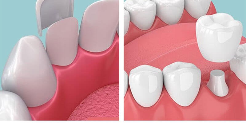 Understanding the Cost Dynamics of Dental Veneers vs. Crowns